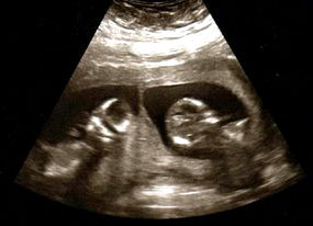 Ultrasound of twins Ultrasound of twins